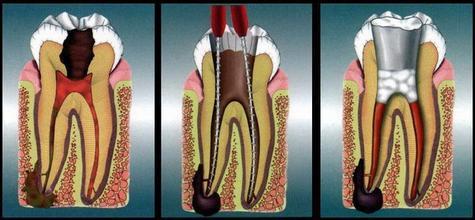 根管治疗的优点有哪些 \